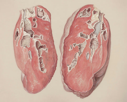 Nuevas guías ASH 2026 para diagnóstico de amiloidosis AL: actuar antes del daño